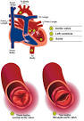 Bicuspid <b>aortic valve</b> alone