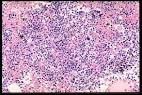 <b>Refractory Anemia</b>