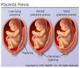 A partial <b>placenta</b> previa