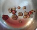 Bladder stones (Vesical Calculi) Bladder stones – Health and ...