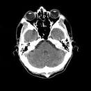 File:Head CT scan.jpg - Wikipedia, the free encyclopedia