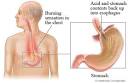 Gastroesophageal Reflux Disease (GERD) - Health.