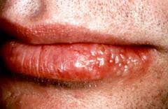  Herpes Labial