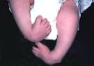 Clubfoot | Seattle Children's Hospital