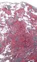 Hypersensitivity pneumonitis - Wikipedia, the free encyclopedia