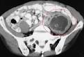 <b>Psoas abscess</b>