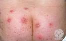 DermIS - <b>Furunculosis</b> (