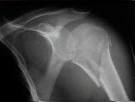 <b>humeral fractures</b>: Can