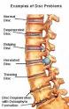 A herniated disc can happen