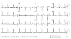 Normal ECG / EKG