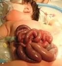 <b>Gastroschisis</b>