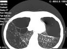 File:<b>Alpha 1</b>-<b>antitrypsine</b>