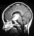 <b>Germinoma</b>. Findings: