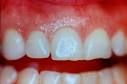 The Treatment of Gum Disease and Periodontitis