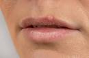 What is a fever blister? | Herpatch (