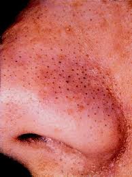 blackheads on nose
