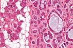 File:<b>Adenoid cystic carcinoma</b>