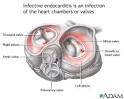 Pathophysiology Of Endocarditis - HealthCentral