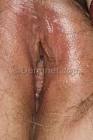 Bacterial Vaginosis Photo - Skin Disease Pictures