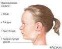 NARCOLEPSY - Diagnosis