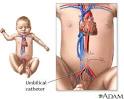 Umbilical catheter