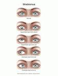 What is <b>esotropia</b>?