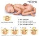 <b>Spina Bifida</b> Oculta is the