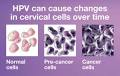 Making Sense of Your Pap &amp; HPV Test Results