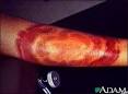<b>Erythema chronicum migrans</b> is