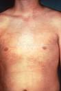 Rheumatology Image Bank : Systemic Juvenile Idiopathic Arthritis: Rash 