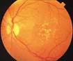 Retinal Atrophy from Macular Degeneration