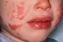 An account on KAWASAKI DISEASEs by using KAWASAKI DISEASE pictures