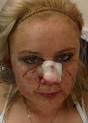 THIS is bloodied Jenna Burns after being confronted by three louts and ... - SNN2825AA280_1318602a