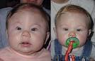 Craniosynostosis Los Angeles - LA County Plastic Surgeons