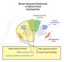 <b>Brown</b>-<b>Sequard Syndrome</b>