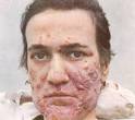 Trądzik - Akne - Acne i łojotok - Seborrhoea - dawne opisy i ...