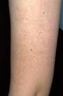 Keratosis Pilaris on the arm.