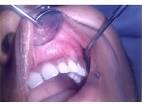 <b>Squamous odontogenic tumour</b>