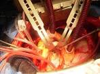 Replacement Of Heart Bypass Surgery By Nanorobot