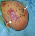 Cancer media and solution: The answer of angiosarcoma
