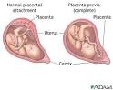 <b>Placenta</b> previa is a condition