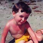 File:<b>Sunburn</b> flickr 02.jpg