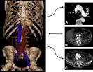 Paradoxical Pulmonary Embolism With Spontaneous Aortocaval Fistula