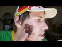 Adam Spencer Leishmaniasis