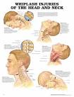 WHIPLASH Associated Disorders - Physiopedia, universal access to.