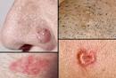 Picture of Basal Cell Carcinoma