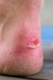 Discovery Health "How Friction Blisters Work"