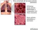 Enfermedad pulmonar obstructiva crónica (
