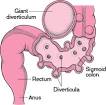Diverticulosis: Diverticular Disease: Merck Manual Home Edition