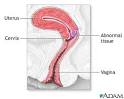 Cervical dysplasia - series: MedlinePlus Medical Encyclopedia